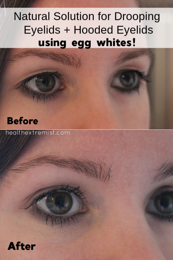 Natural Remedy for Drooping Eyelids and Hooded Eyelids Using Egg Whites - I apply the egg white to my upper eyelid, let it dry and see a big improvement.