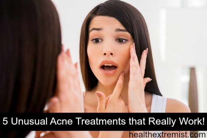 5 Unusual Acne Treatments That Really Work!