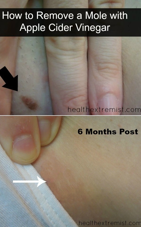 Apple cider vinegar mole removal experiment before and after pictures. The mole is completely gone with no scarring.