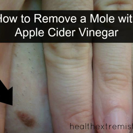My Apple Cider Vinegar Mole Removal Experiment Worked! - The mole was gone in 4 days with no scarring left now.