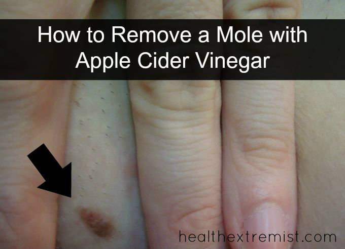 My Apple Cider Vinegar Mole Removal Experiment Worked!
