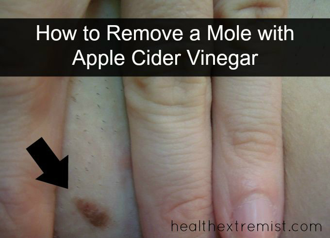 Apple Juice Vinegar To Treat Moles