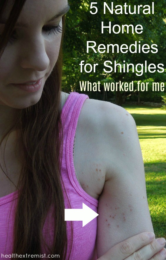 5 Natural Home Remedies for Shingles - What helped me with pain, reduced burning, and dried up the outbreak quiker.