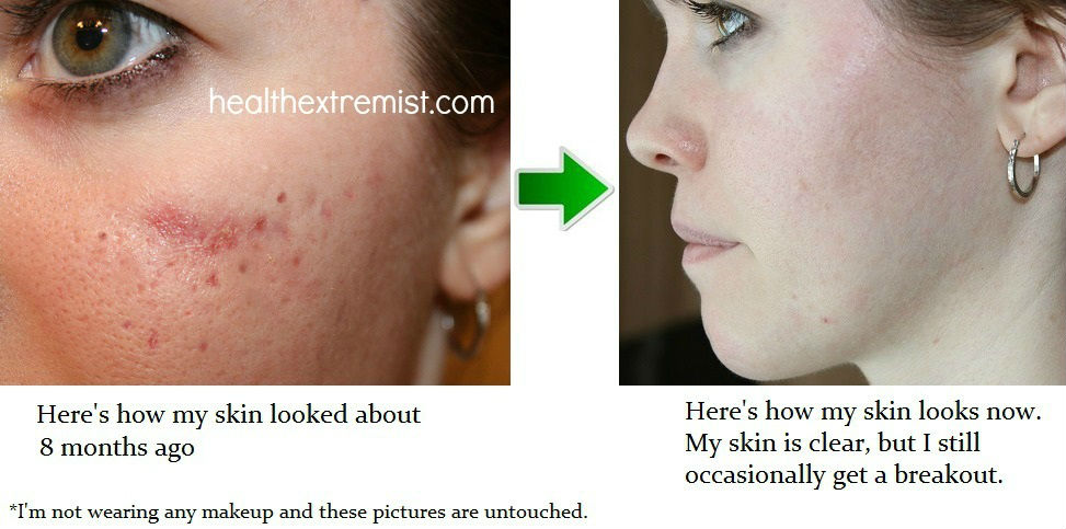 acne-before-and-after123