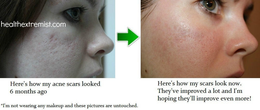 acne-scars-before-and-after-pictures123
